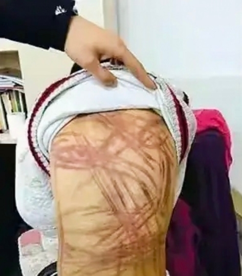 一名男子为了将女儿丢给前妻抚养,竟动不动就用电线,皮带抽打女儿