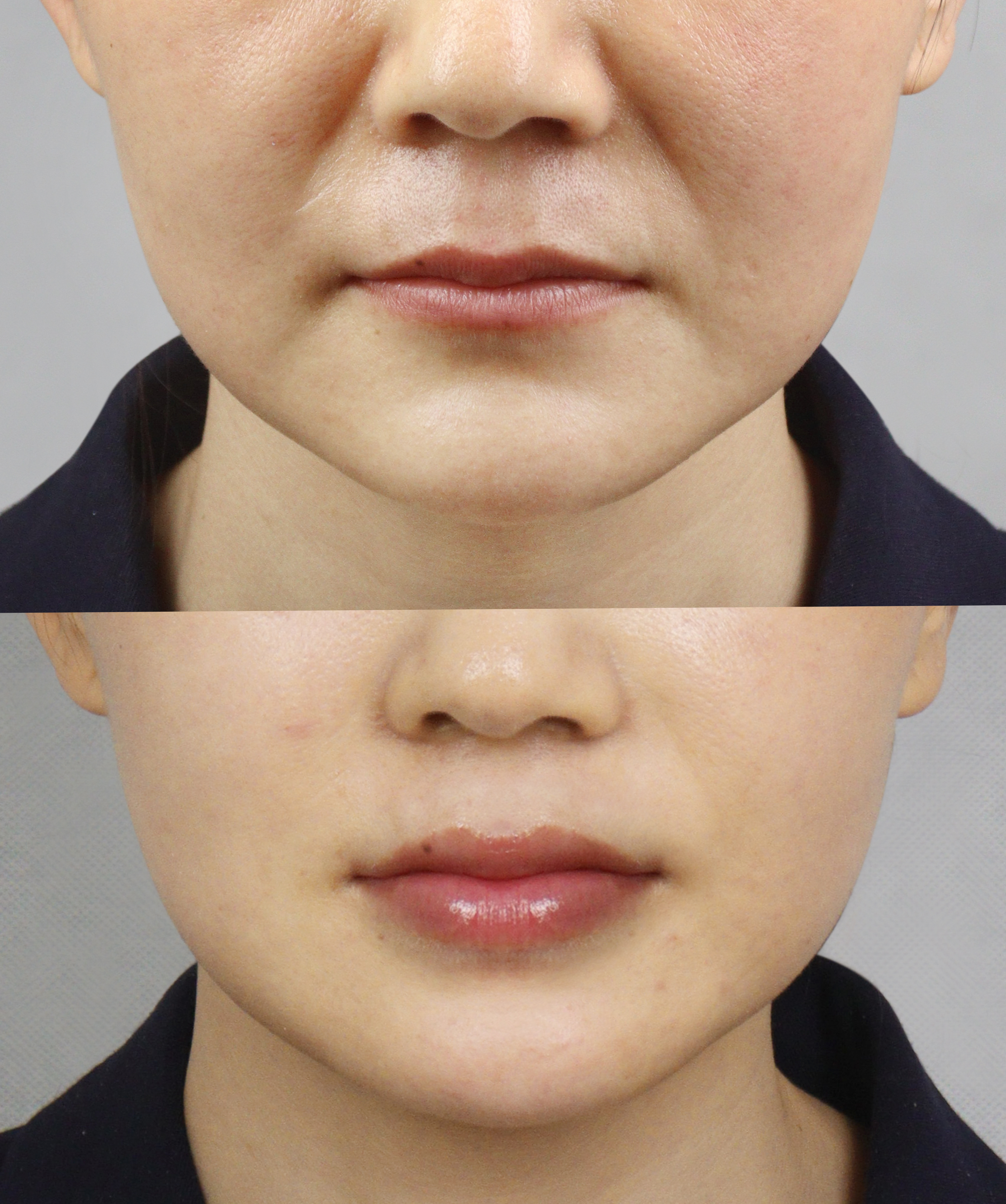 咱说实话,45 岁那阵儿,我那法令纹深的哟,笑起来跟俩括号似的,直愣愣