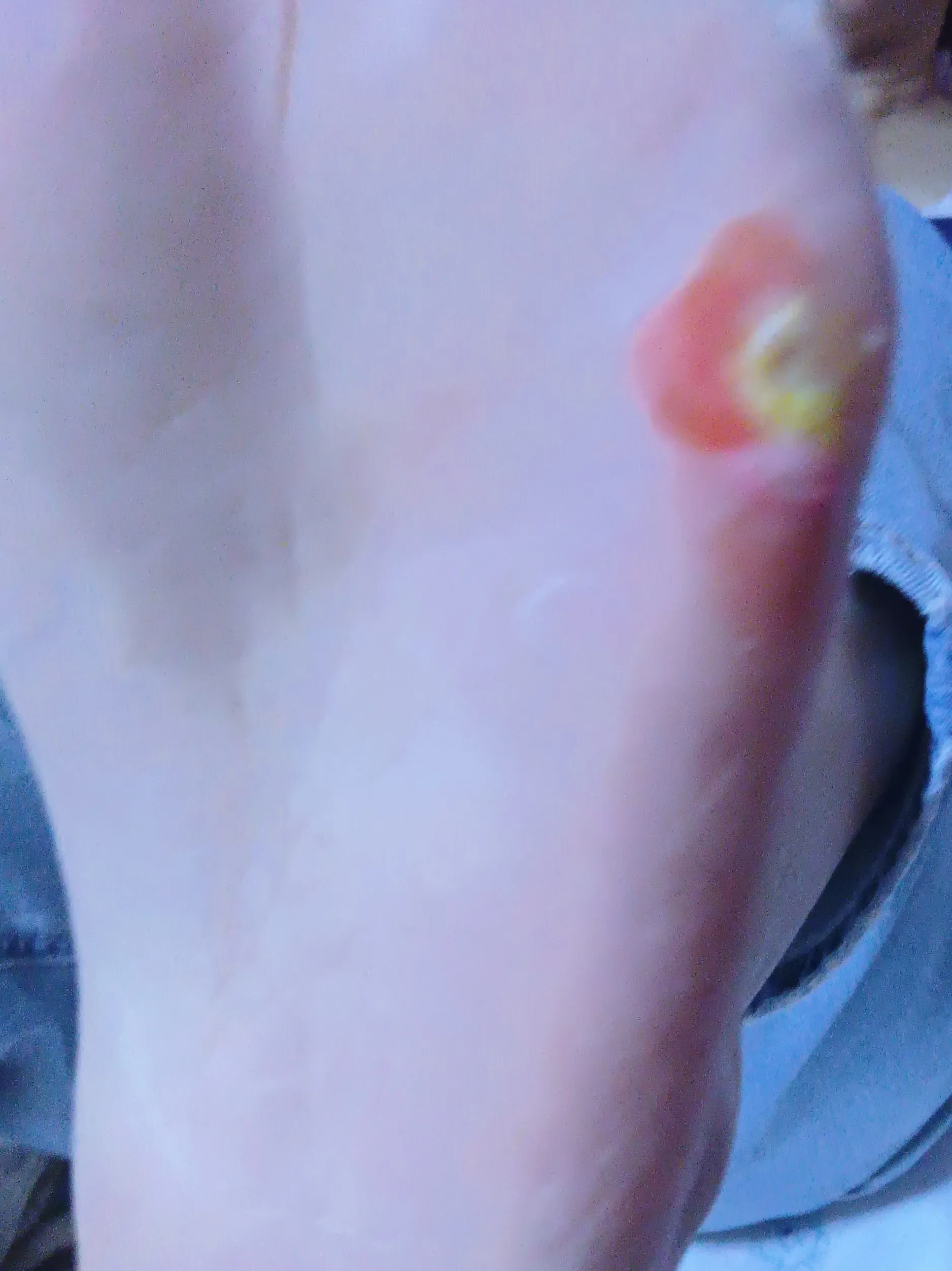让医生给看看,医生给开了鸡眼膏让贴,贴了几天好了
