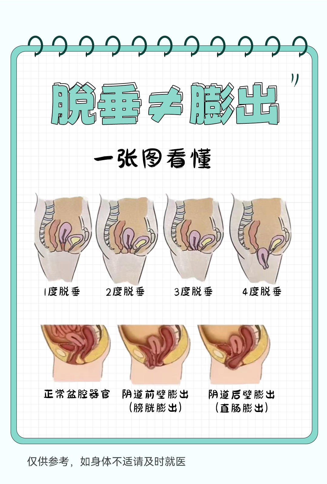 很多人容易把"子宫脱垂"和"阴道膨出"