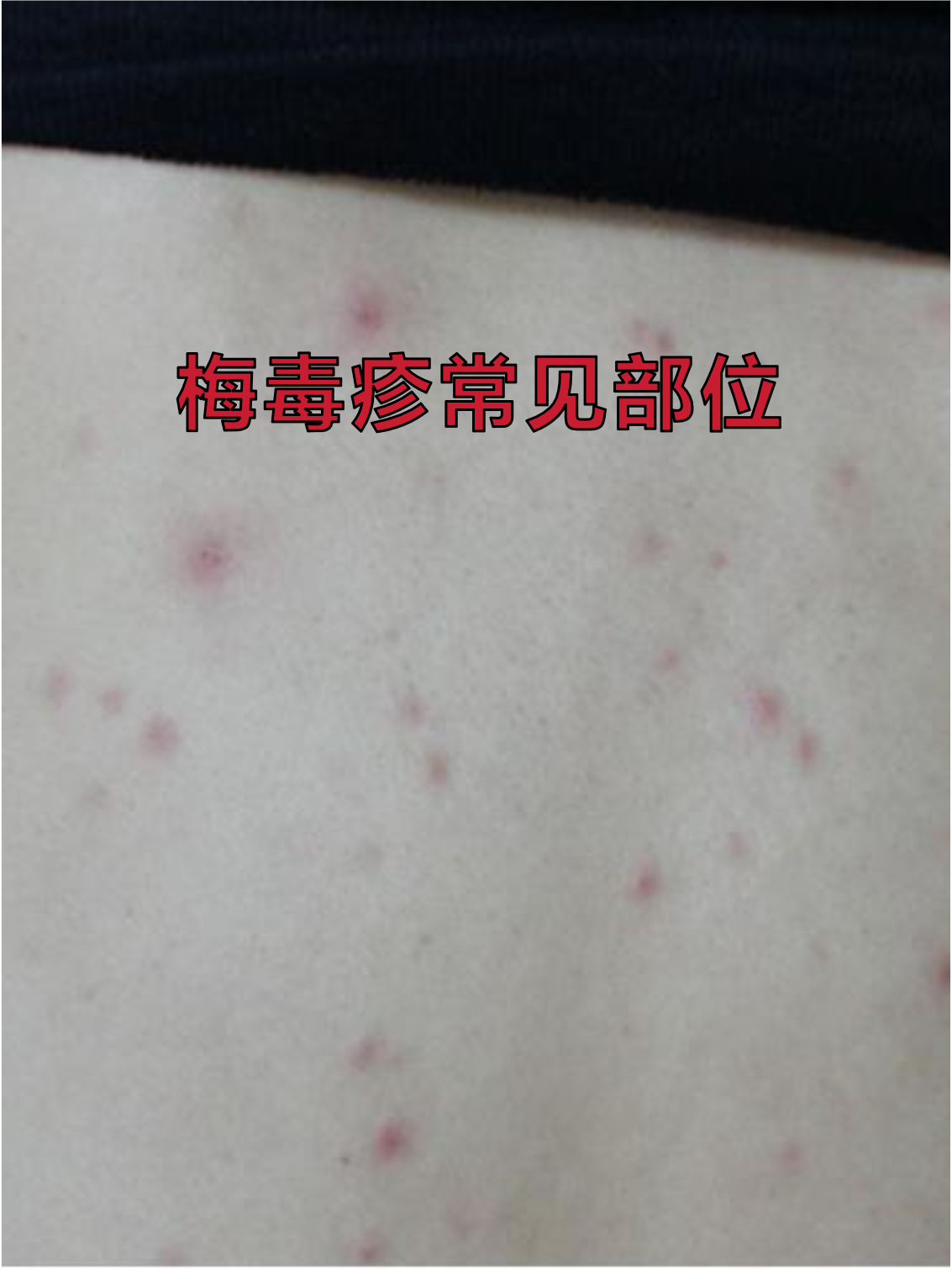 梅毒疹是二期梅毒的典型表现,这种皮肤症状往往在不