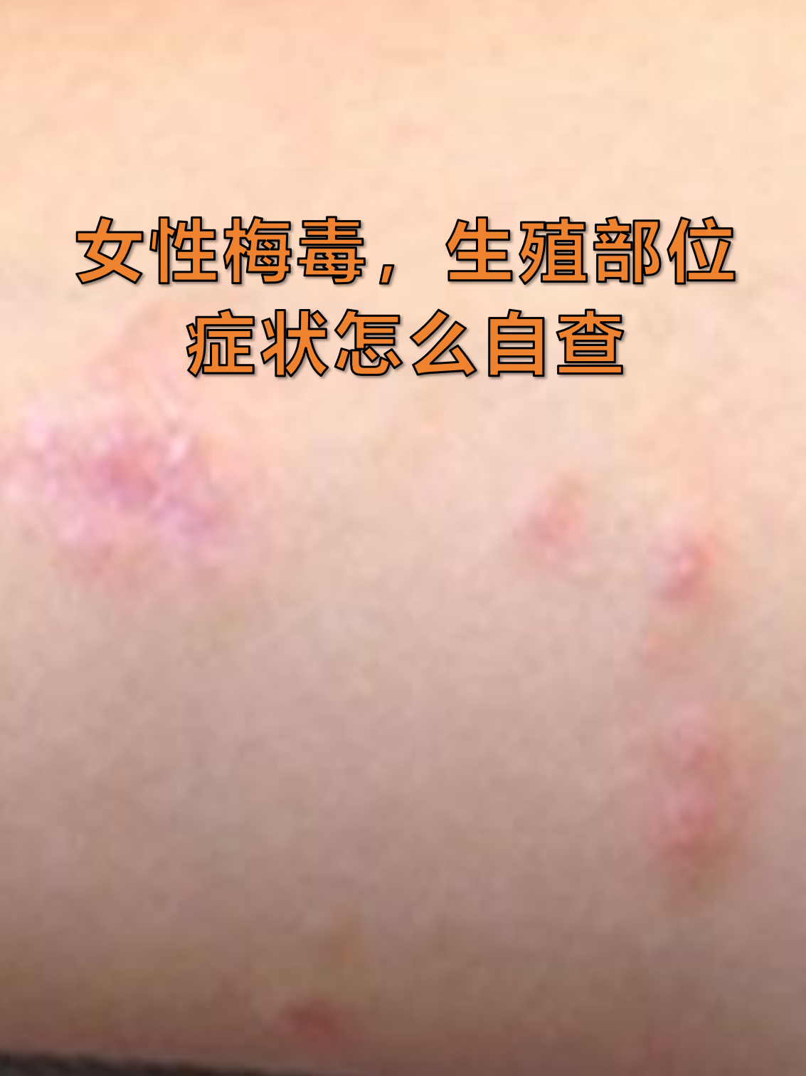 女性梅毒,生殖部位症状怎么自查