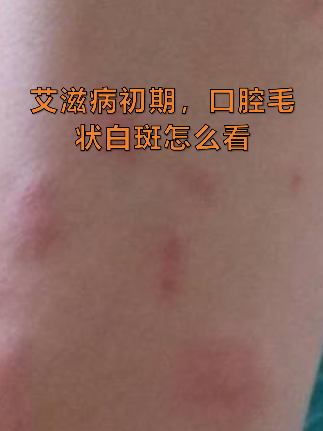 艾滋病初期,口腔毛状白斑怎么看