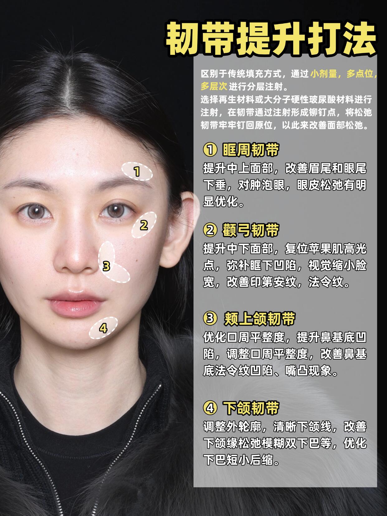 选择再生材料或大分子硬性玻尿酸材料进行注射在韧