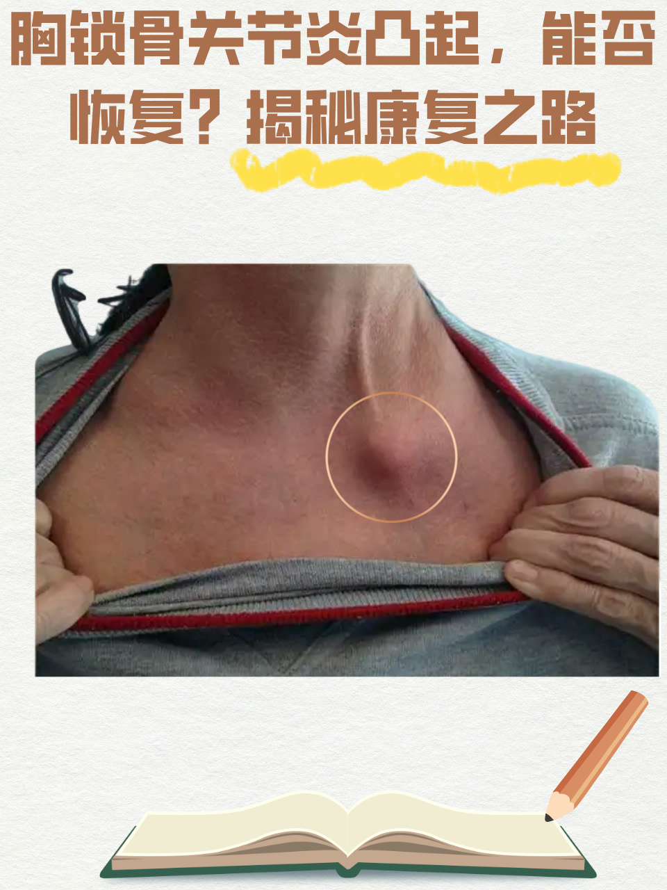 胸锁骨关节炎凸起,能否恢复?