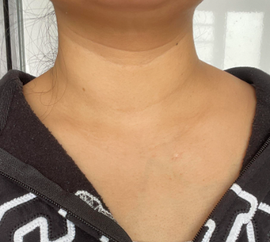 脖子粗是甲状腺出问题了吗?关乎这 4 种常见情况!