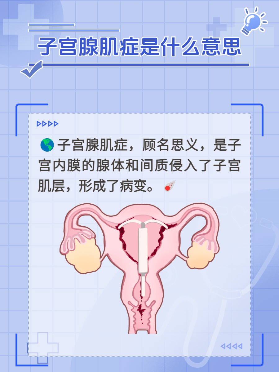 子宫腺肌症是怎么得的图片