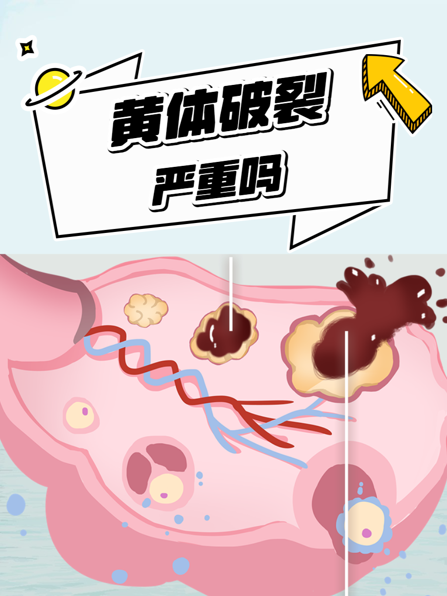但是,当黄体破裂时,女性的健康可能会受到严重威胁