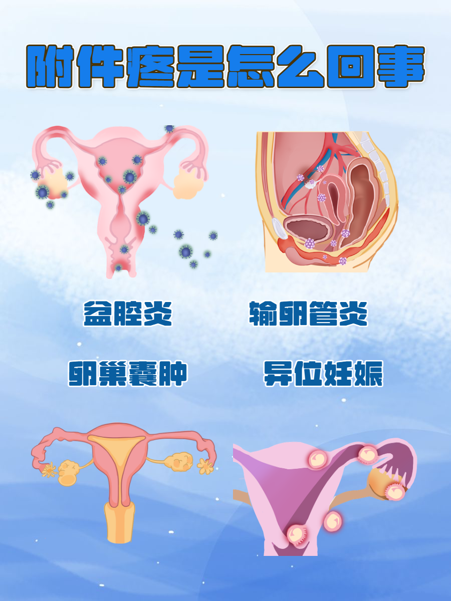 附件疼痛是一种常见的健康问题,影响着许多女性