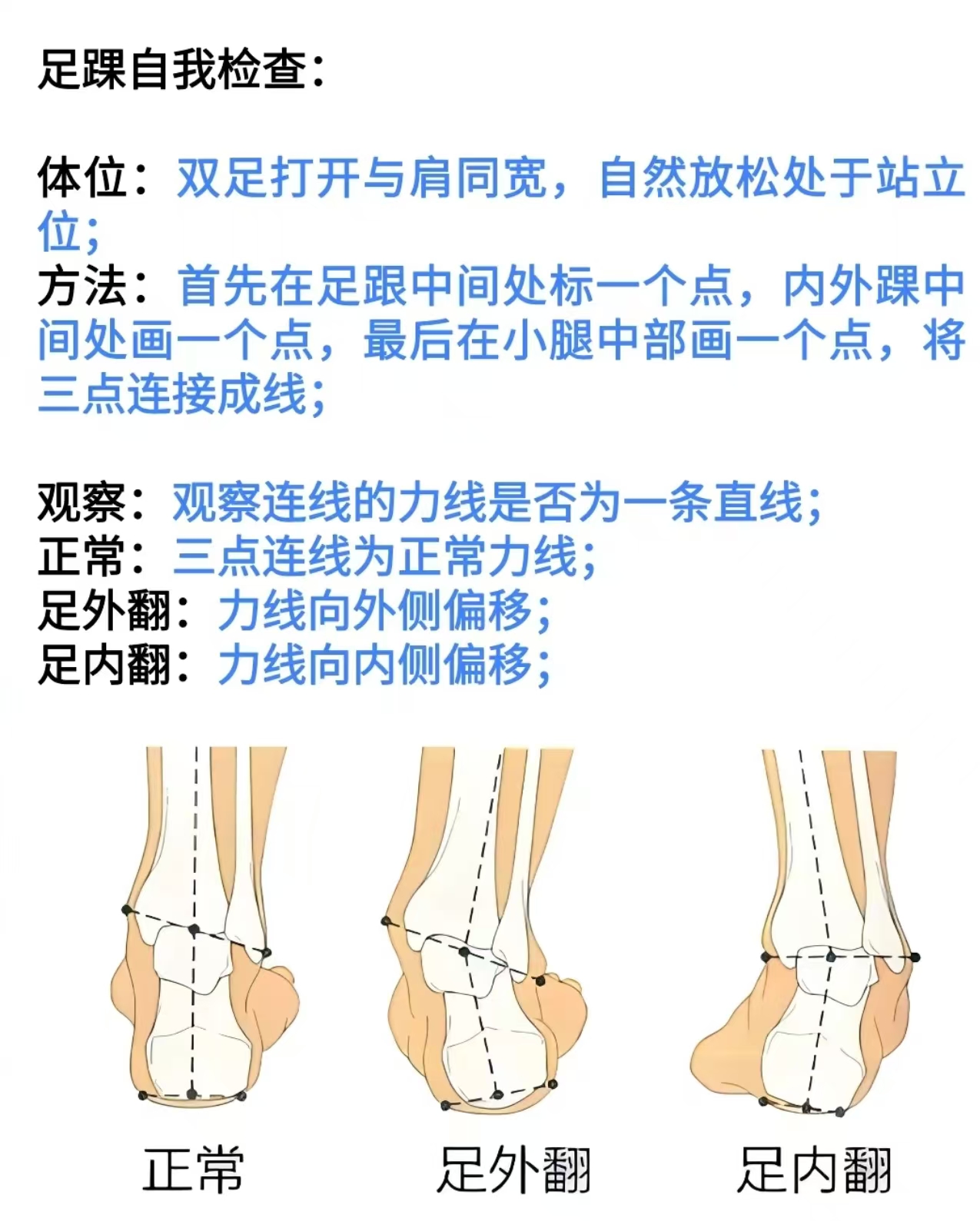 足踝外翻矫正方法图片