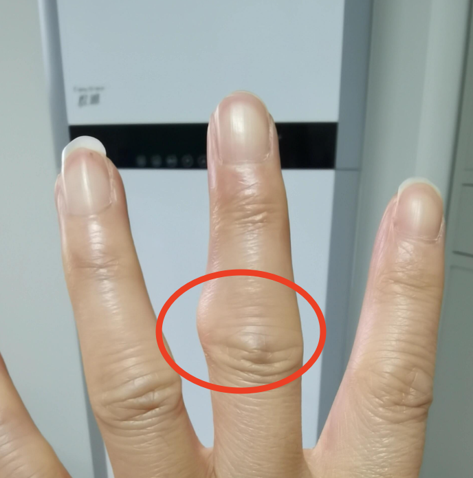 没受到外伤为什么手指关节肿了