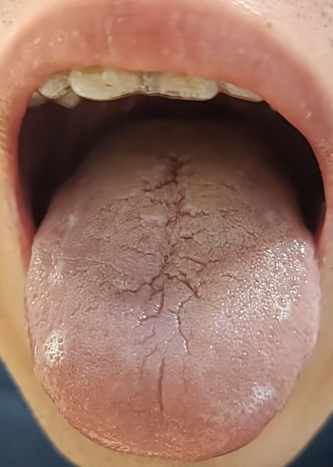 为什么有的人舌头两半黑为什么在线 为什么有的人舌头两半黑为什么在线