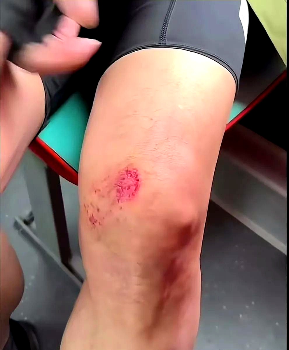 他两个膝盖都磕破了,不过他说骨头和筋都没事,就是肩膀有点疼