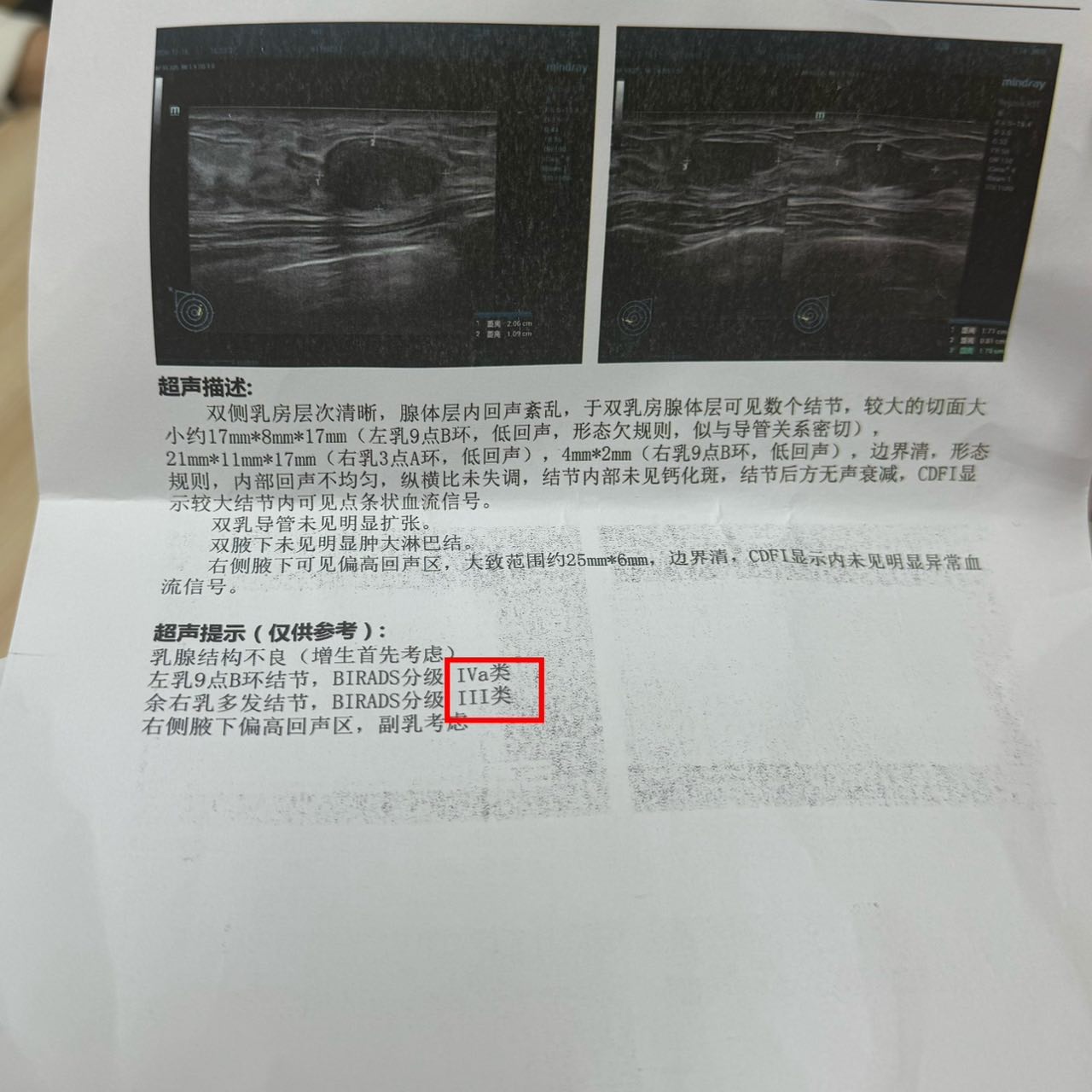乳腺结节4a又怎样?