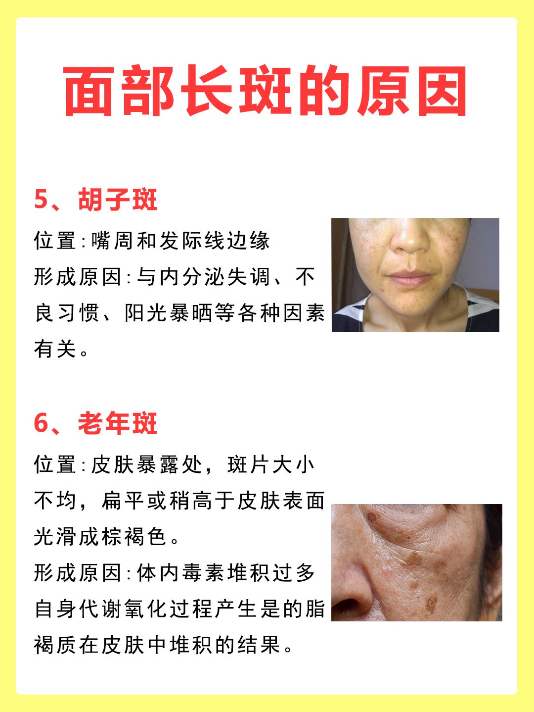 脸上长斑是因为什么原因引起的 脸上长斑是因为什么原因引起的