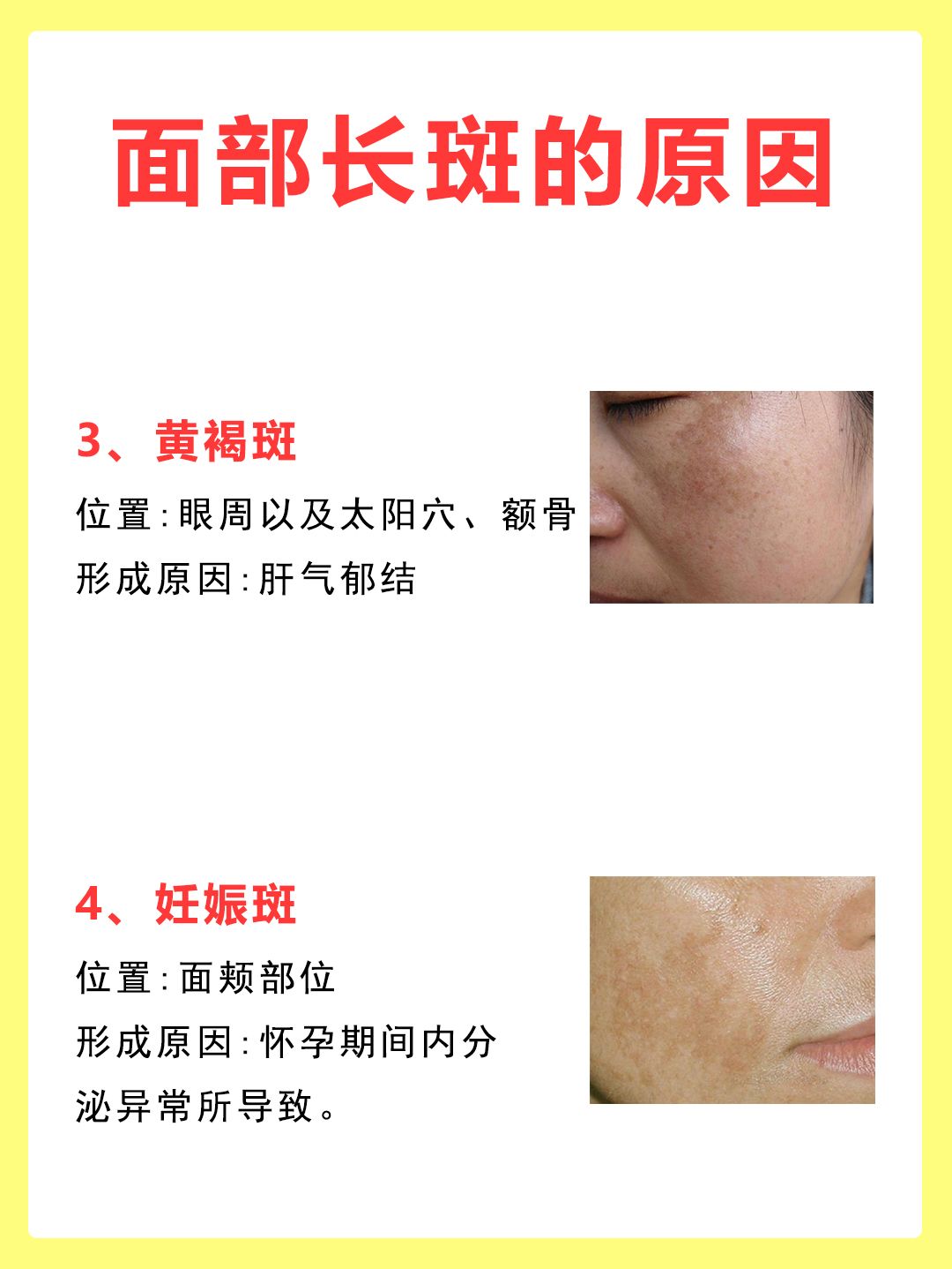 看看你的色斑是哪种吧