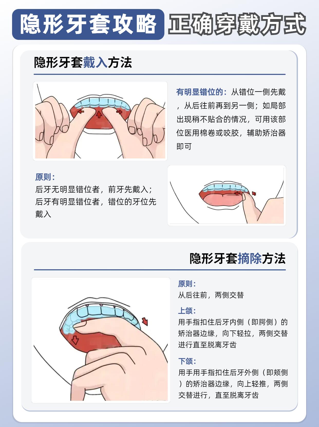 隐形牙套4大攻略?1秒掌握,笑容开挂不是梦!