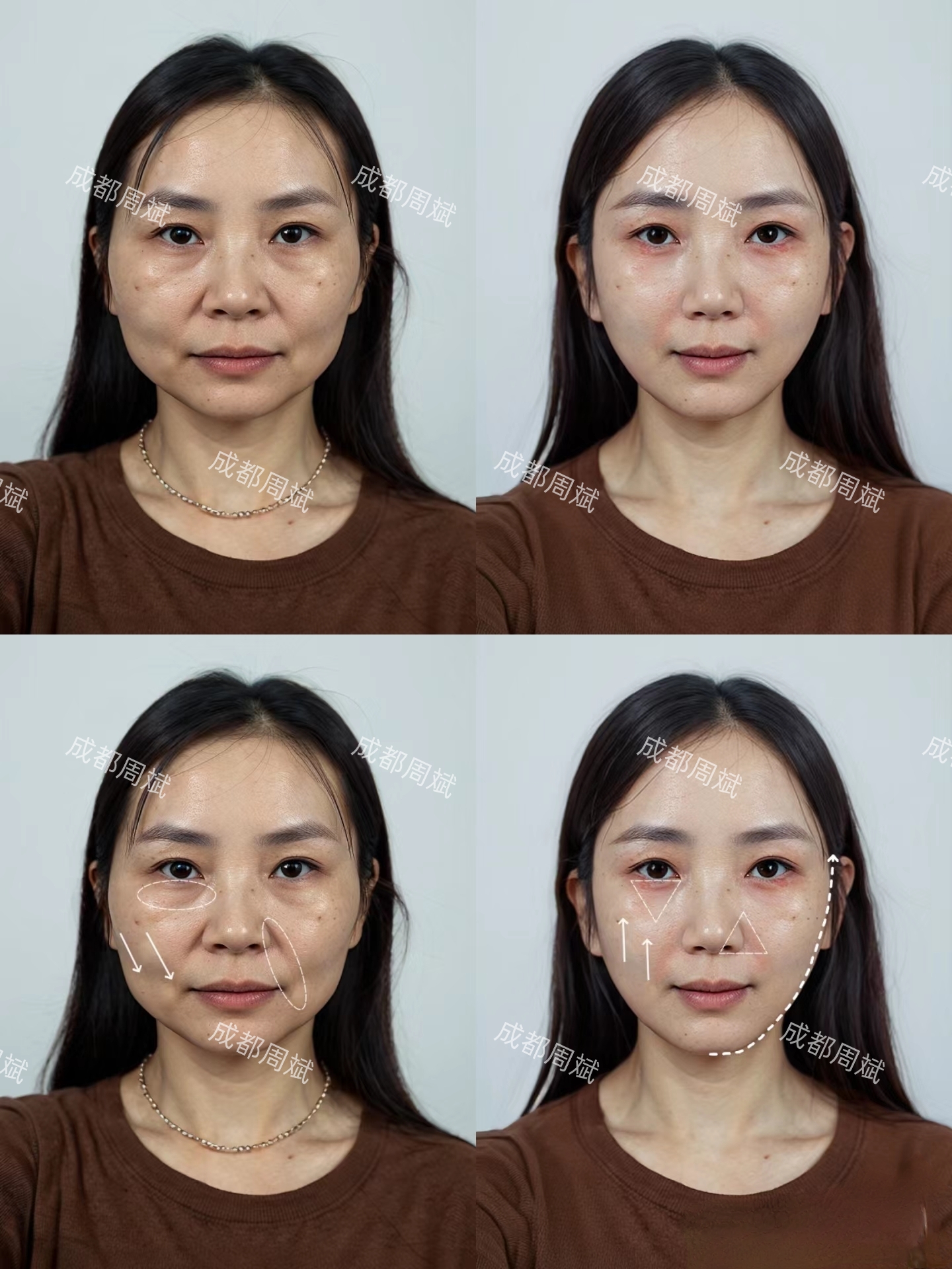 但五官真的很容易出美女严重的问题在于下巴平且软组织堆积在下颌两侧