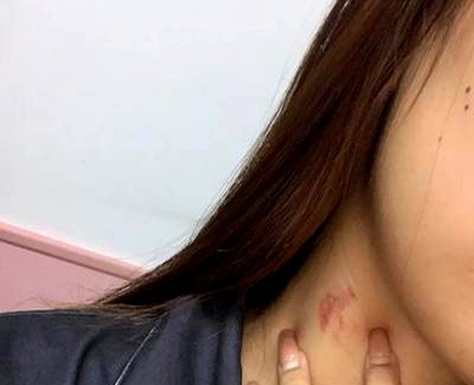 脖子上种草莓草莓脖子脖子被吸草莓图片脖子上草莓图片男草莓印图片