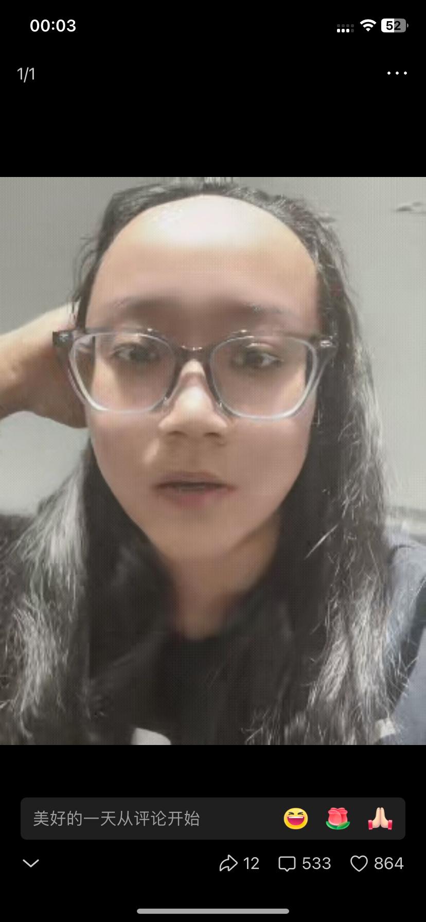 浙江有个姑娘,她的额头天生就很大,发际线超高,头发怎么都遮不住