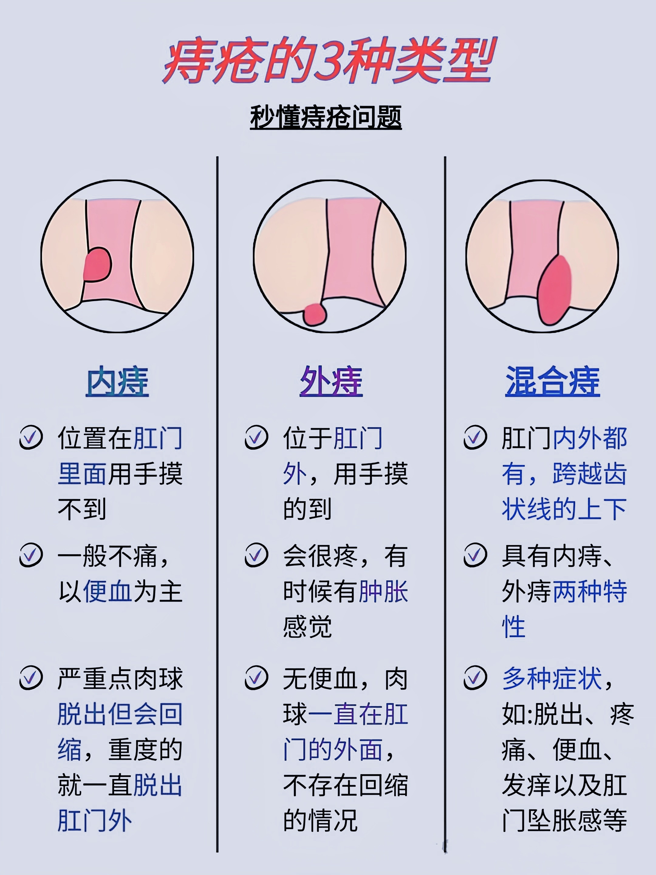 痔疮大概可以分为这3种症型,快看你是第几种吧!