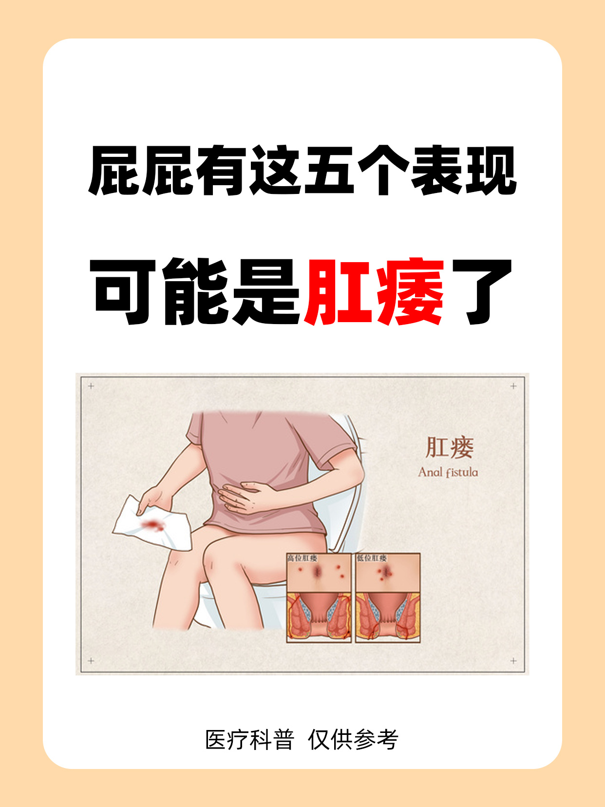 屁屁有这5个表现,可能是肛瘘了,你占了几点?#肛瘘# #肛瘘手术