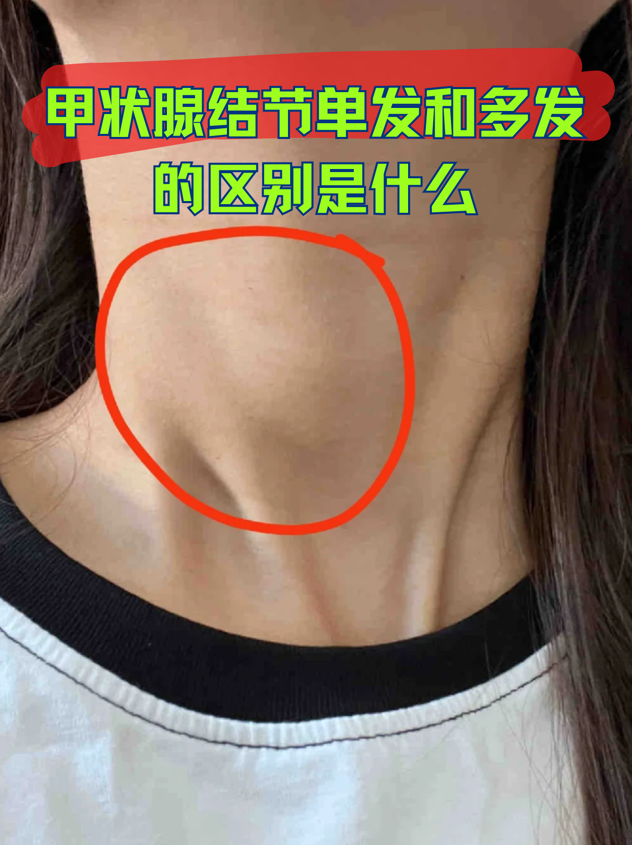 甲状腺结节单发和多发的区别是什么