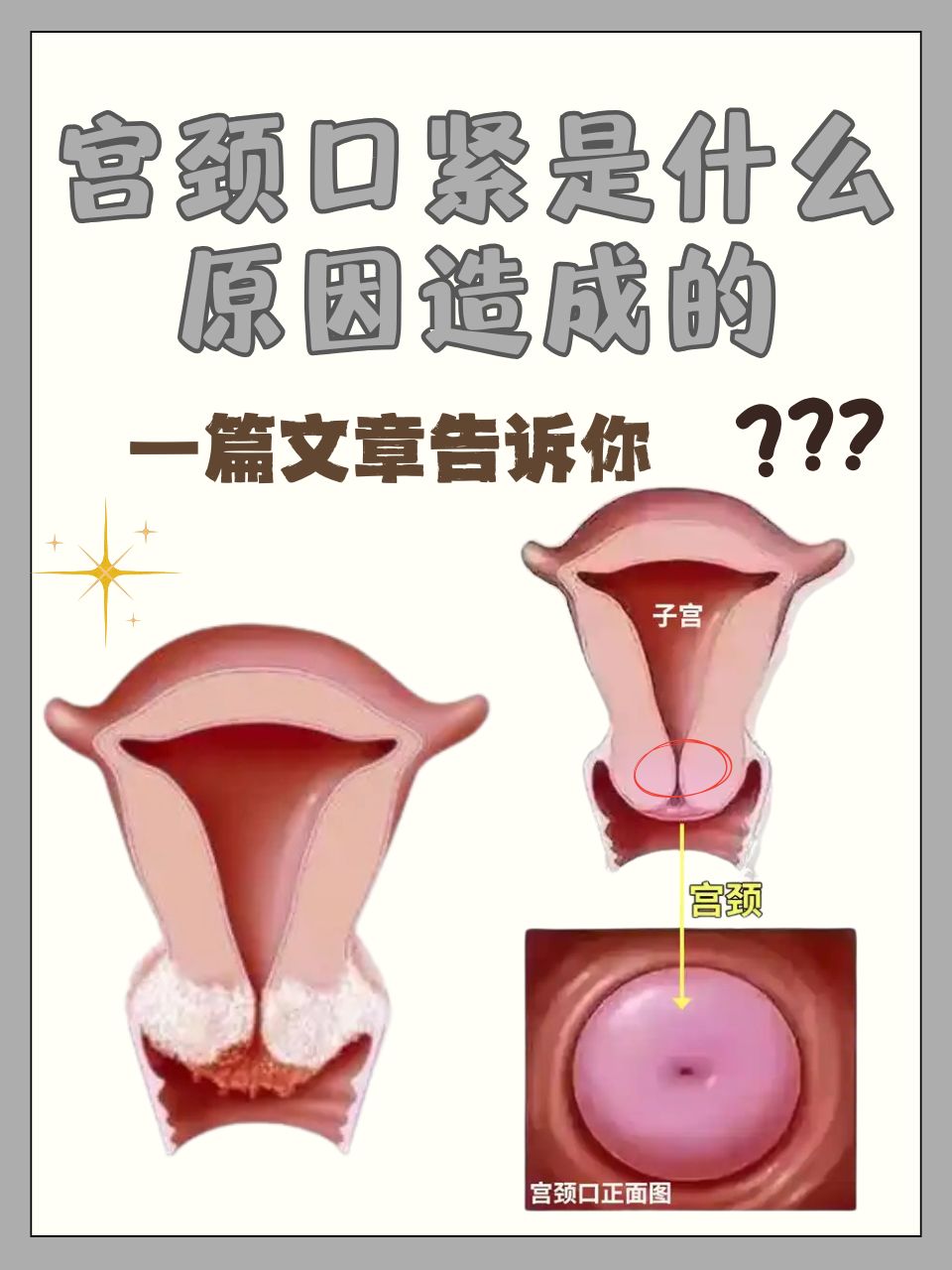 那么,宫颈口紧是什么原因造成的?很多人不是很清楚,本文将详细解答