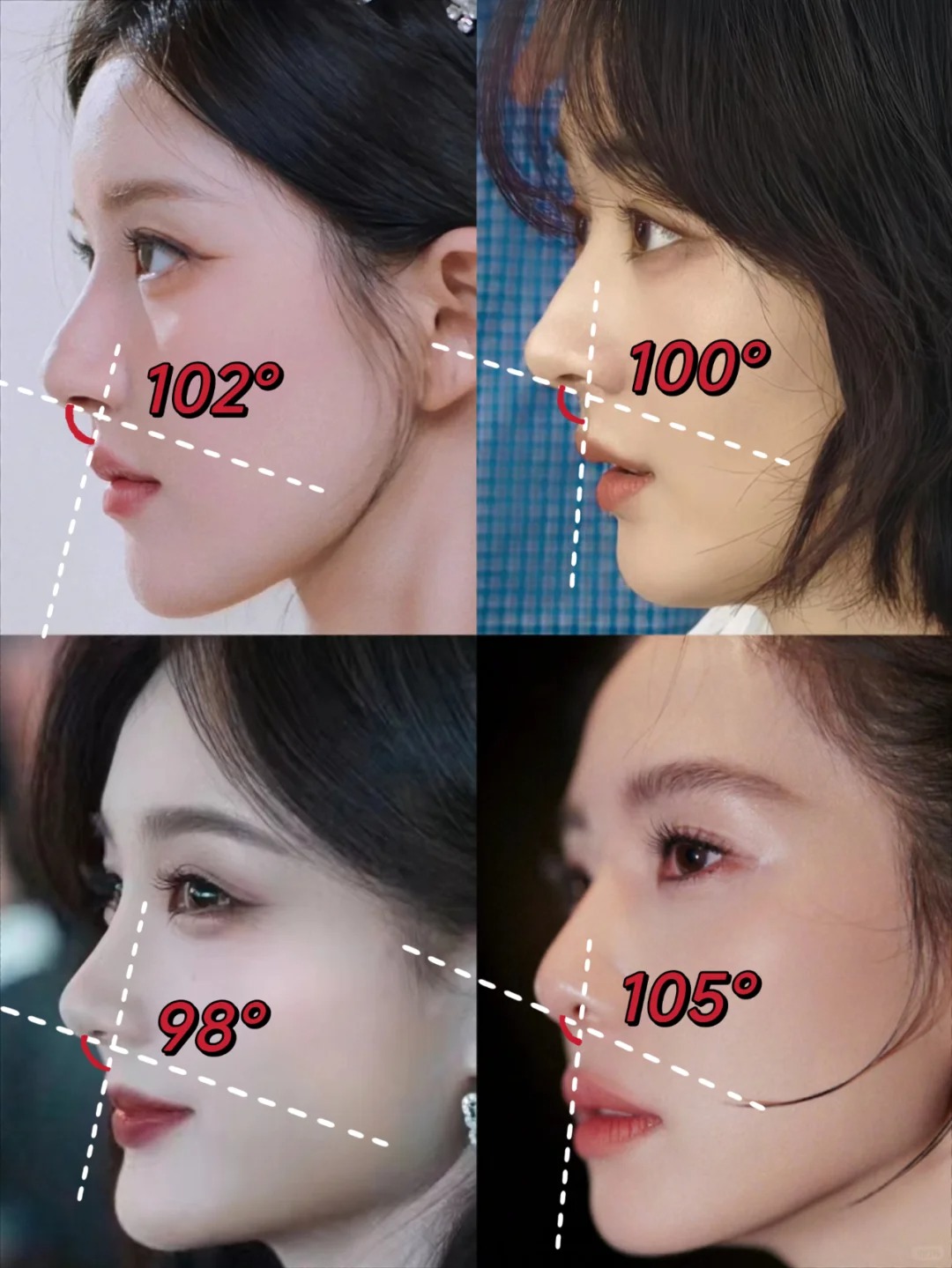 人面部立体度的关键指标,而鼻唇角度恰恰是影响侧面立体度的核心所在