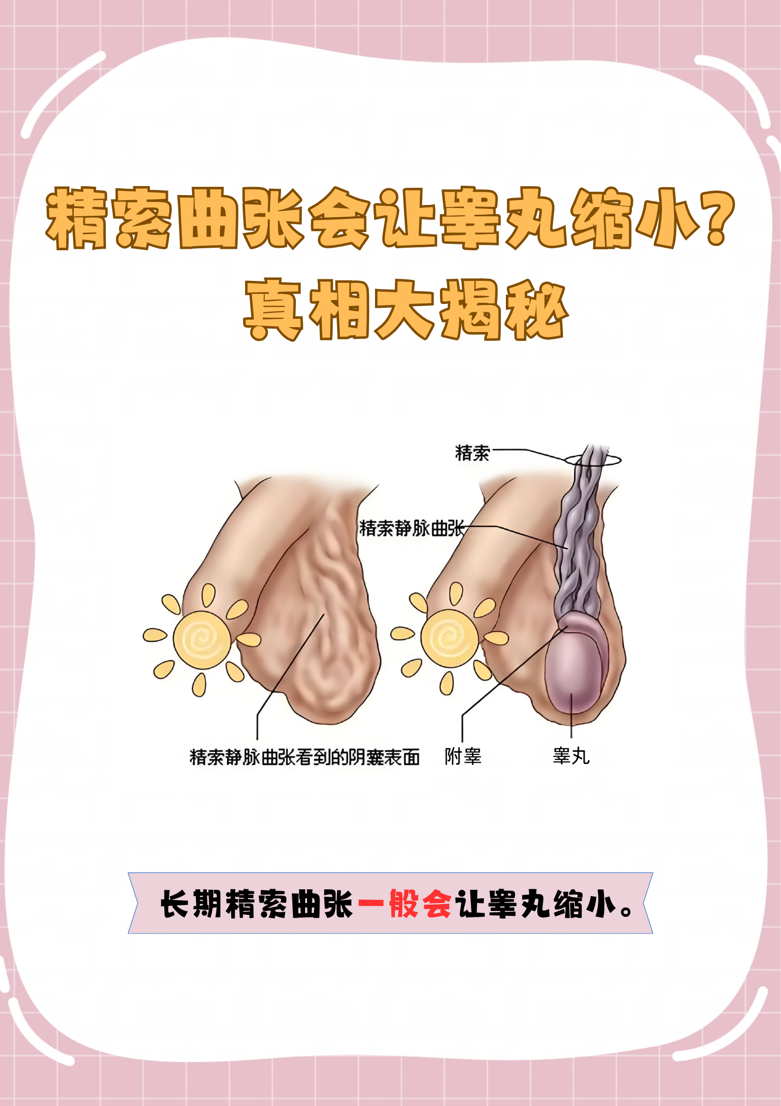 血液循环受阻:精索静脉曲张使静脉血回流正常睾丸外观正常睾丸下垂