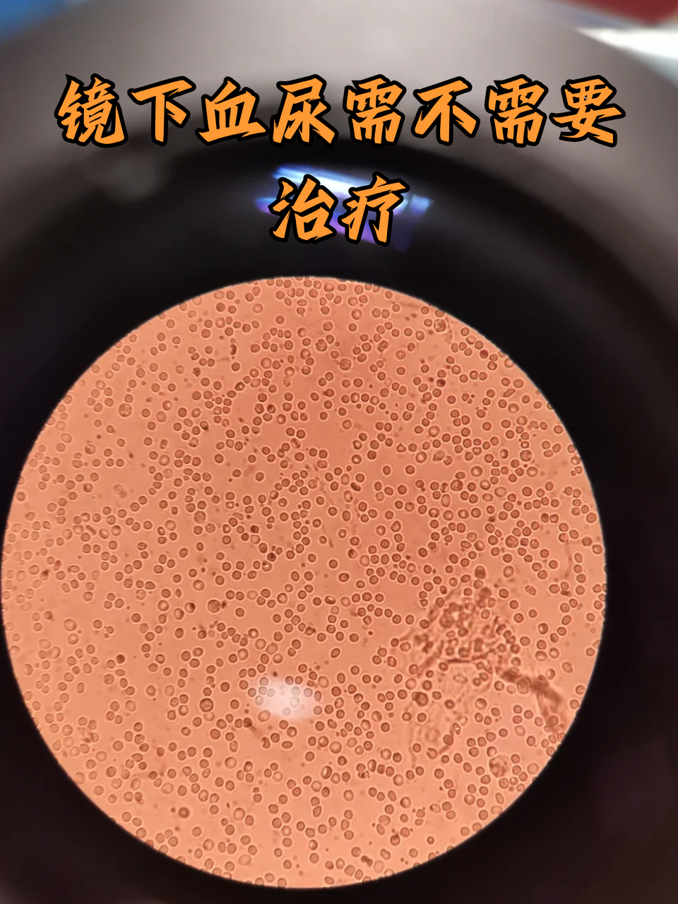 镜下血尿需不需要治疗