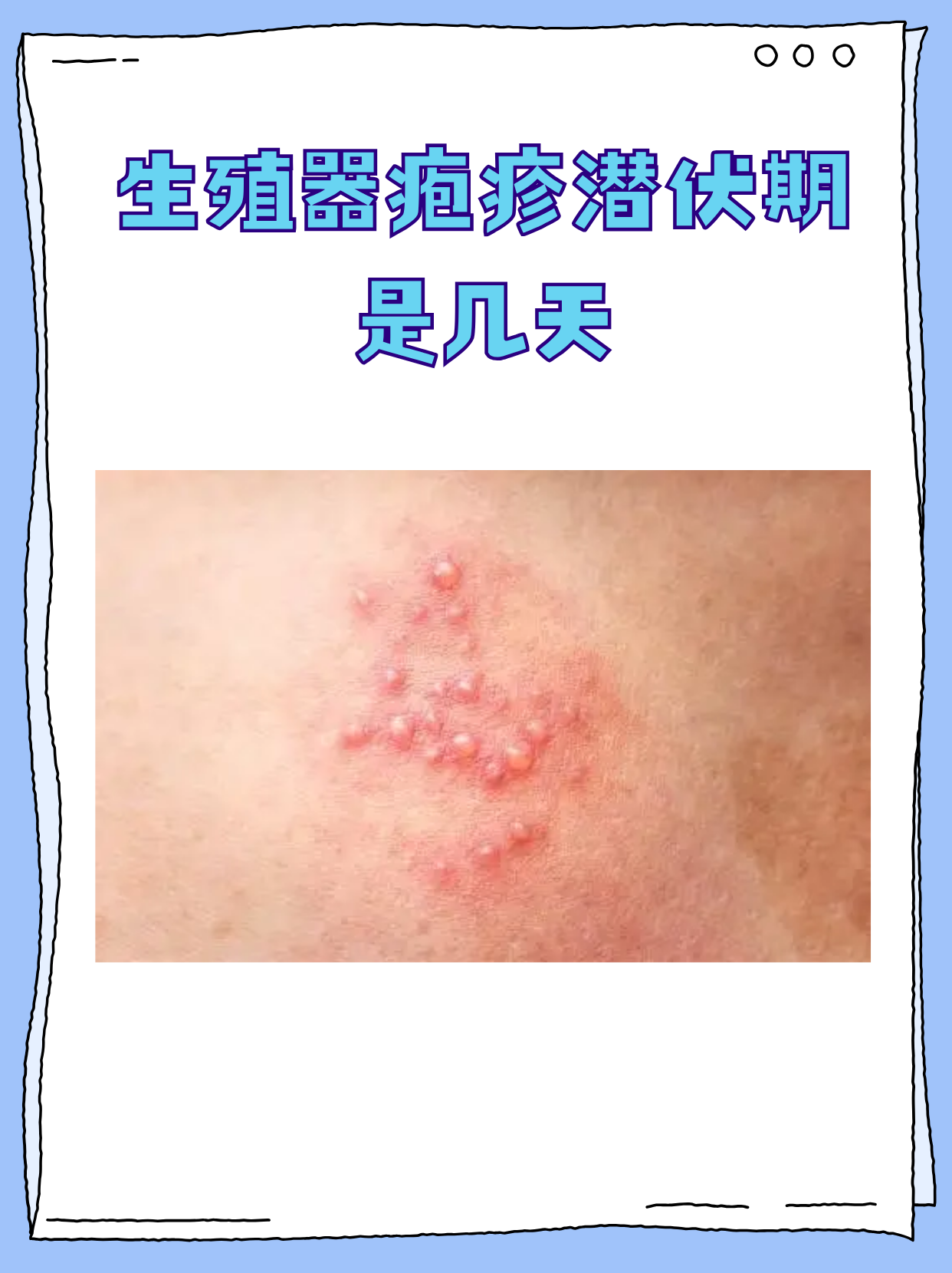 生殖器疱疹潜伏期是几天