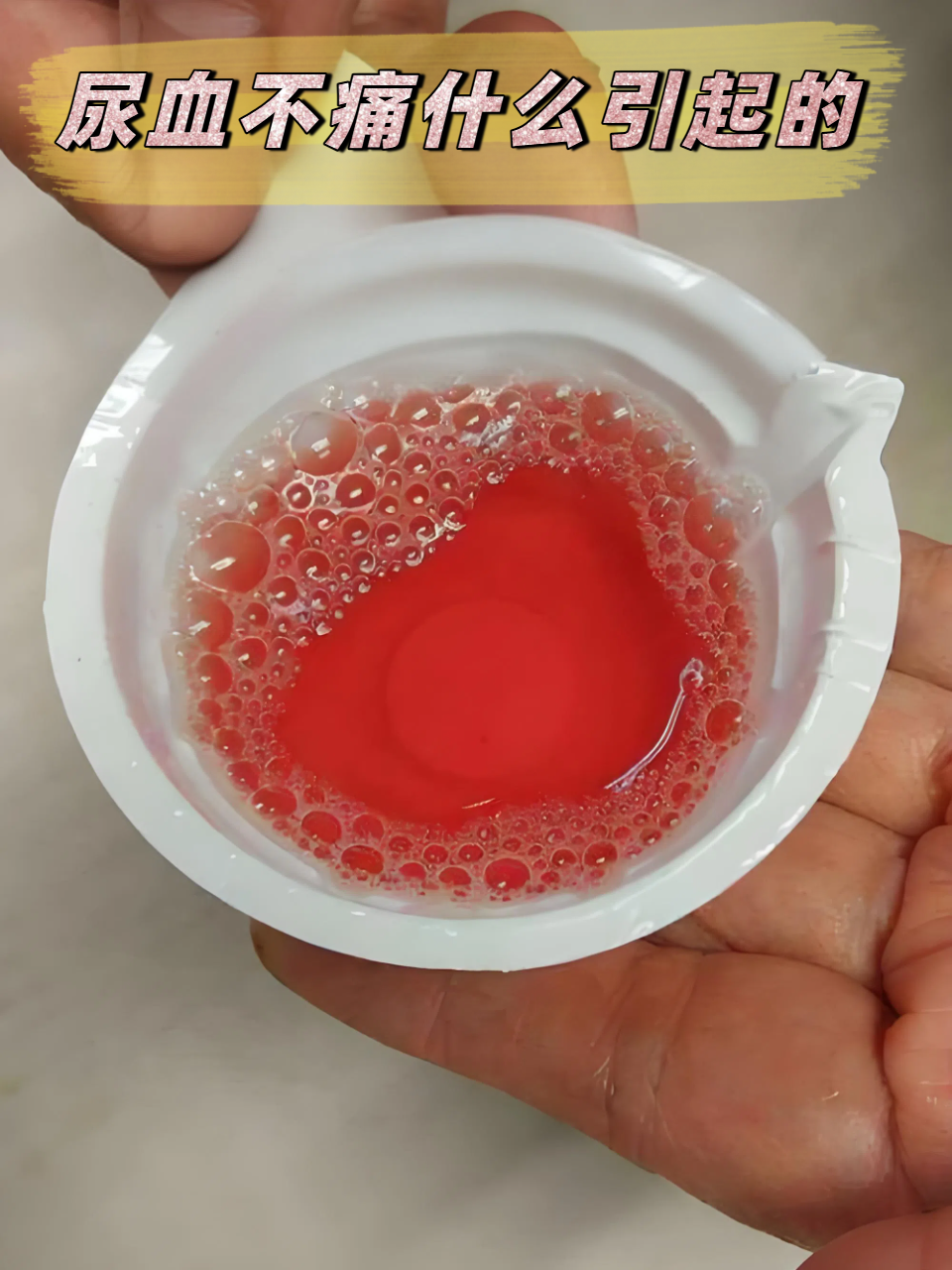 其实无痛性血尿可能提示多种泌尿系统问题,从轻微炎症到严重疾病均有