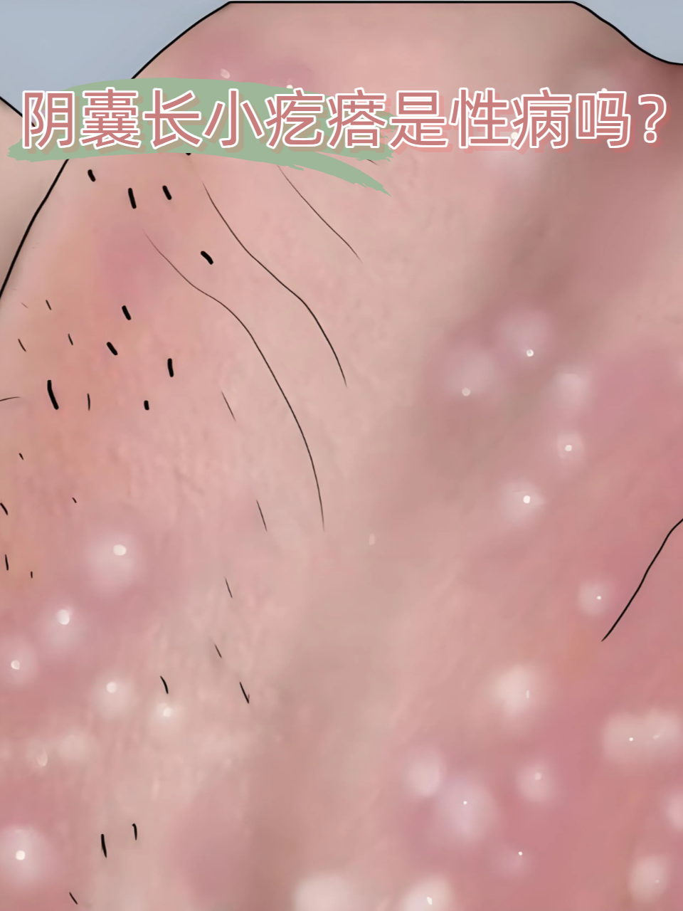 阴囊皮肤偶尔冒出小疙瘩,很多人第一反应就是性病恐慌