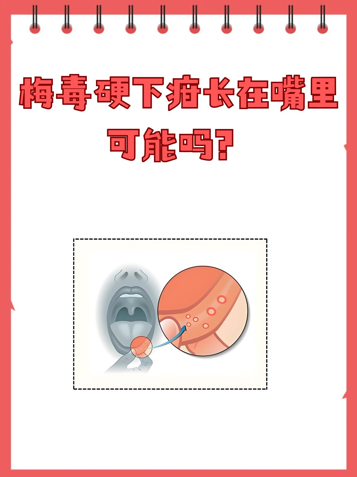 梅毒硬下疳确实可能出现在口腔,这种看似隐蔽的感染位置常被误认为