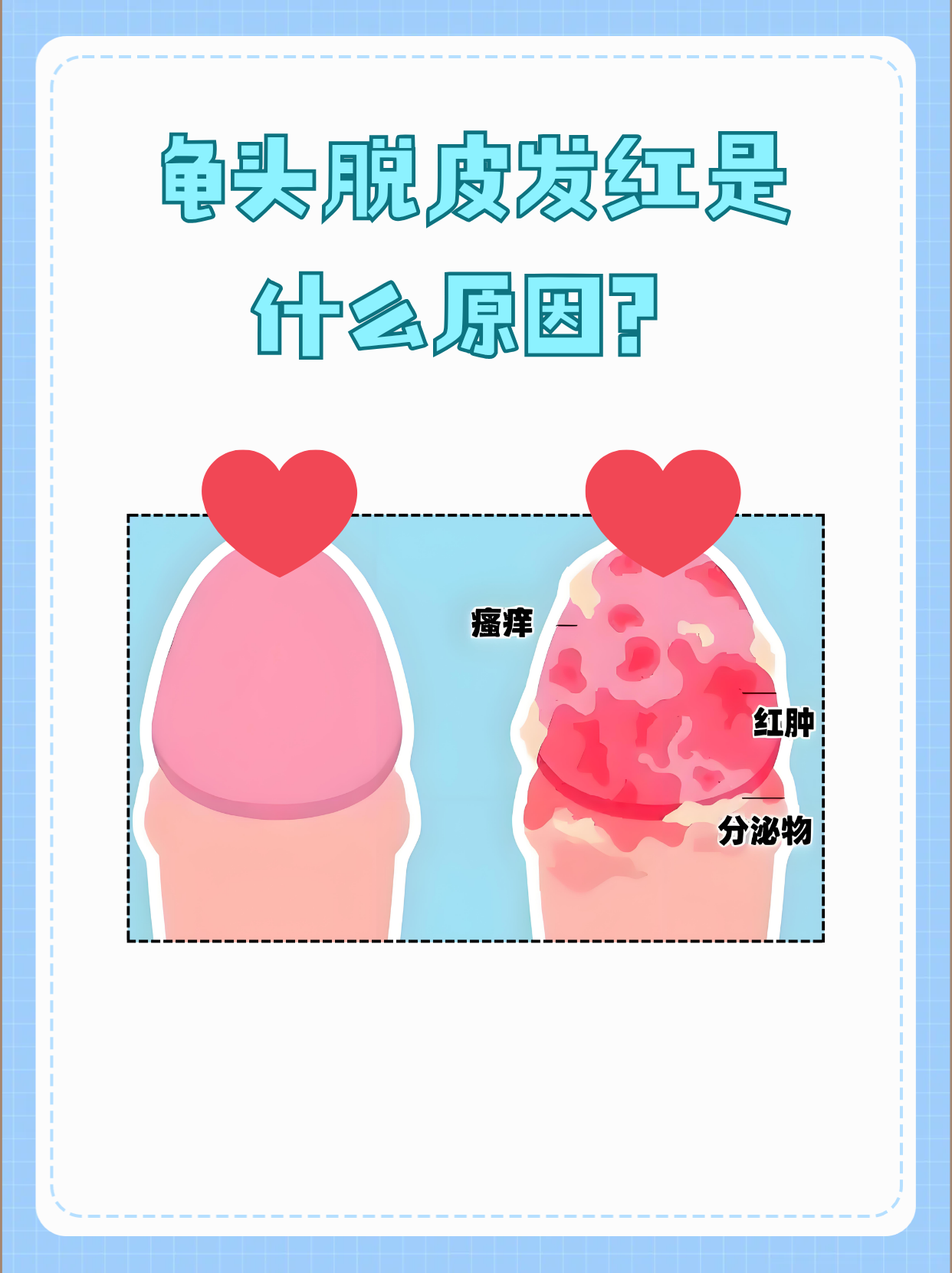 龟头脱皮发红是什么原因?