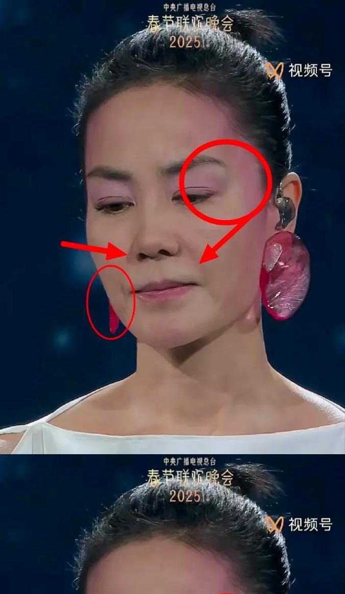 毫无疑问,她明显做了提拉,眉尾和眼角处一道线分明.干细胞,童颜