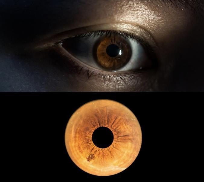 就是利用高清摄影工具捕捉人 虹膜表面凸起虹膜错构瘤图片虹膜色素痣