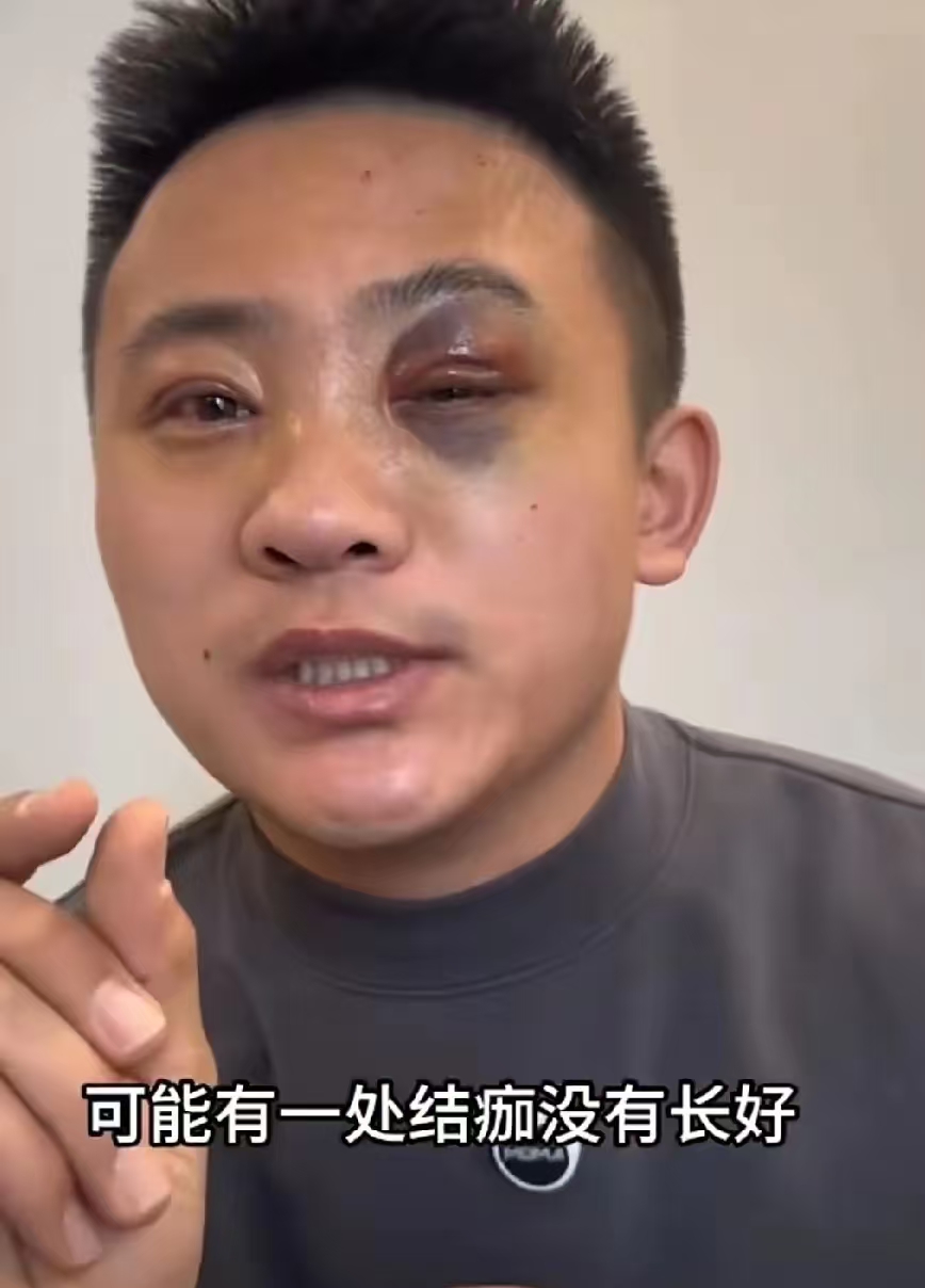 男子割双眼皮后一只眼睛血肿久久不消,两只眼睛形成明显对比,又去同一