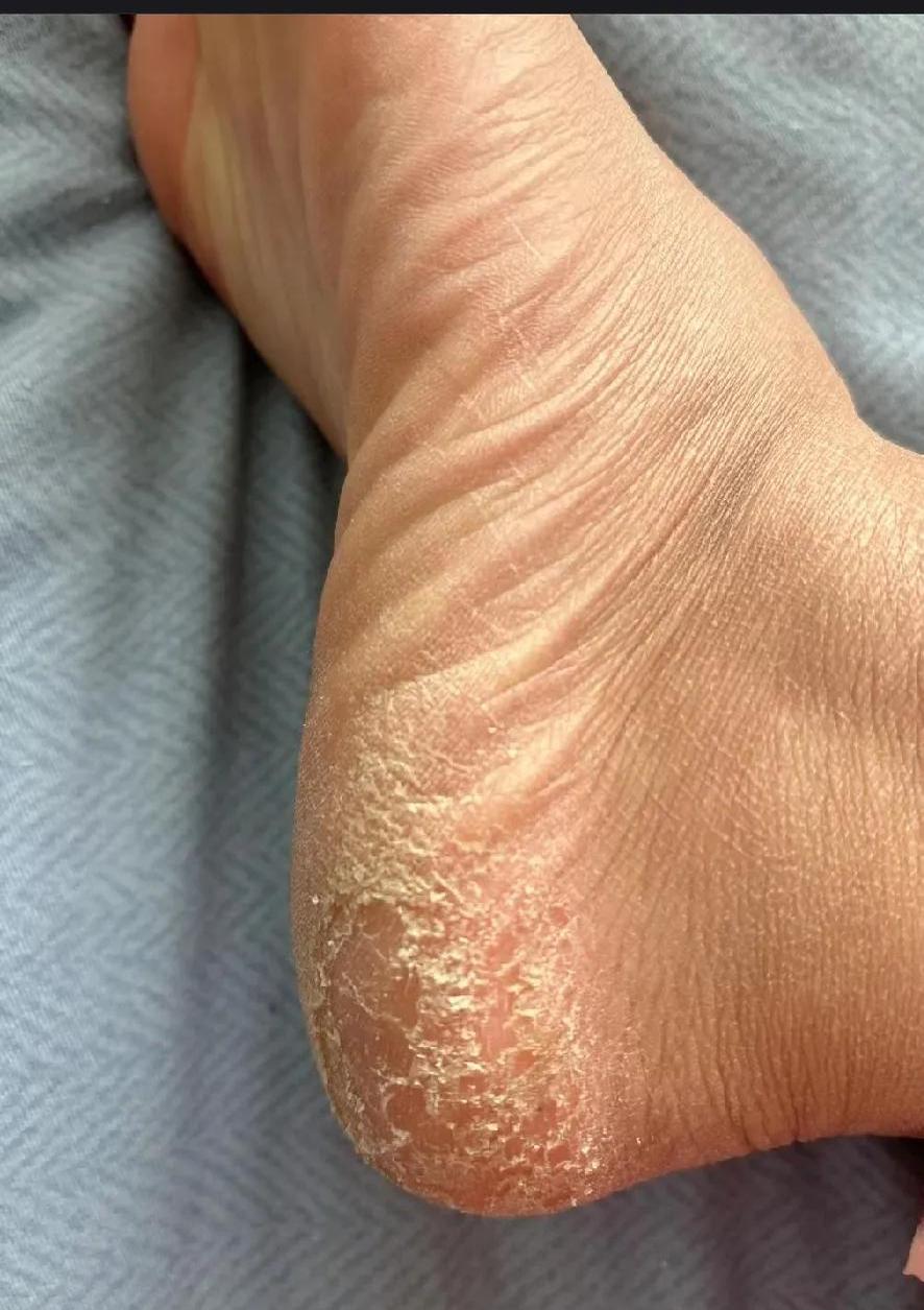 家人们,一到冬季,我这脚后跟就像沙漠一样,干得直起皮,脱袜子的时候