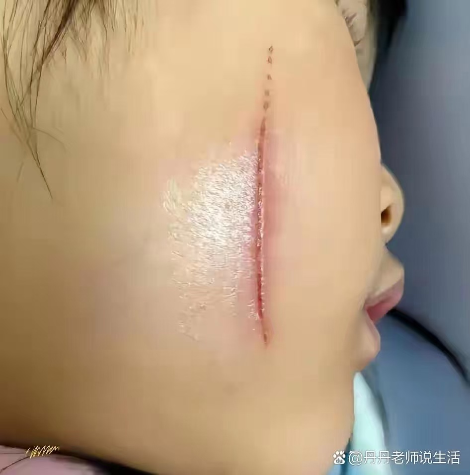 孩子受伤后,我们一直用完美芦荟胶给她擦脸