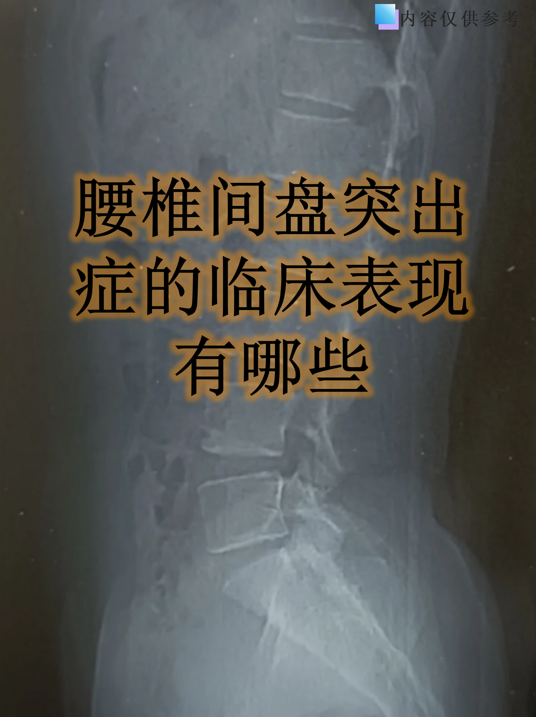 腰椎间盘突出症的临床表现有哪些