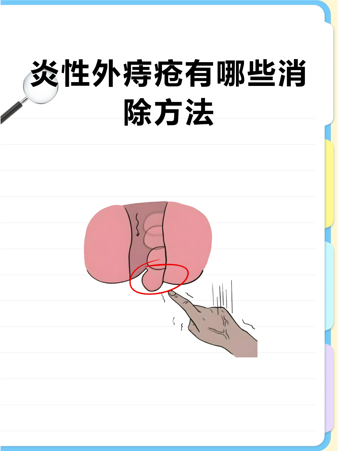 炎性外痔疮有哪些消除方法