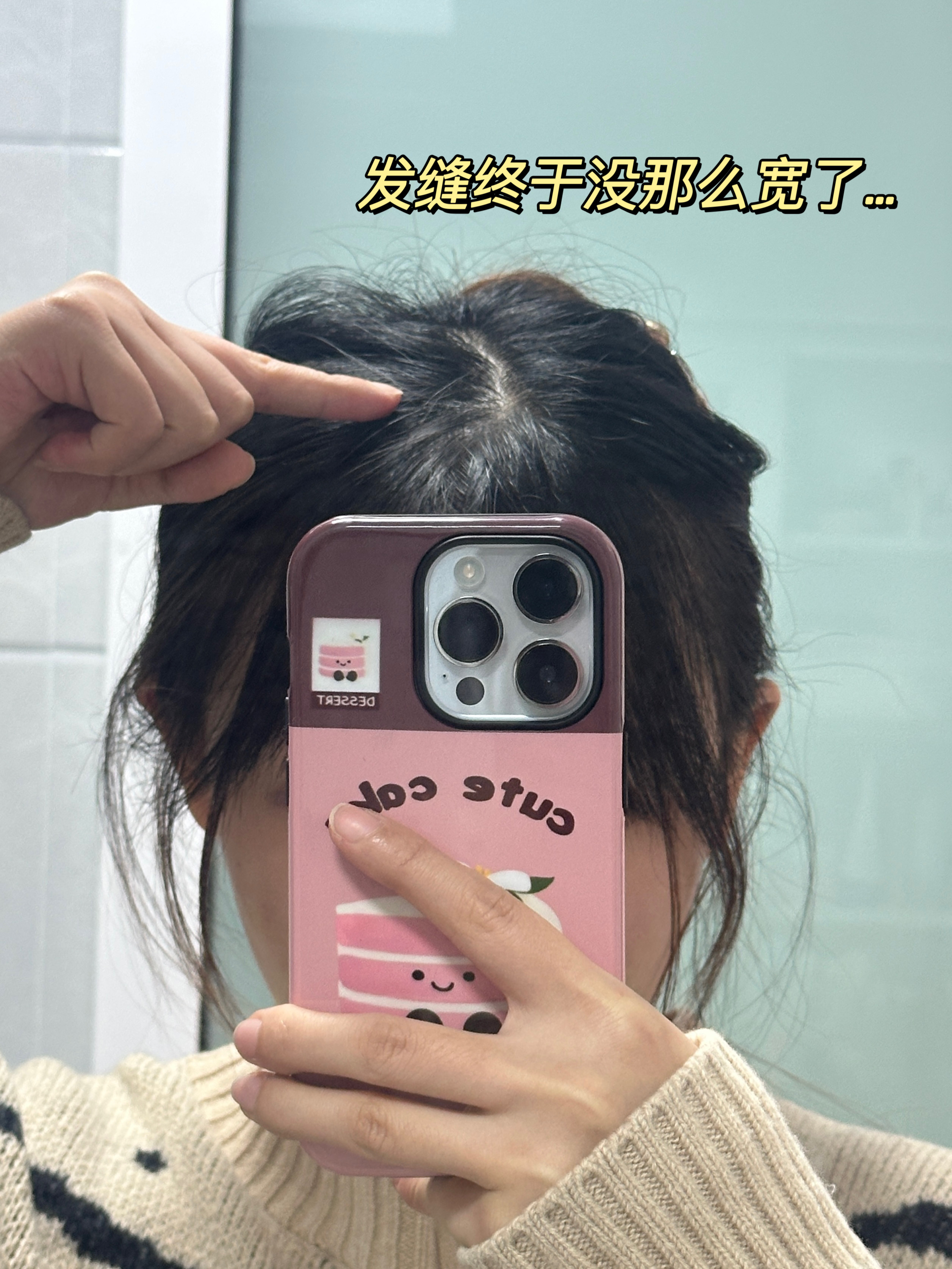 重度脱发的20个冷知识
