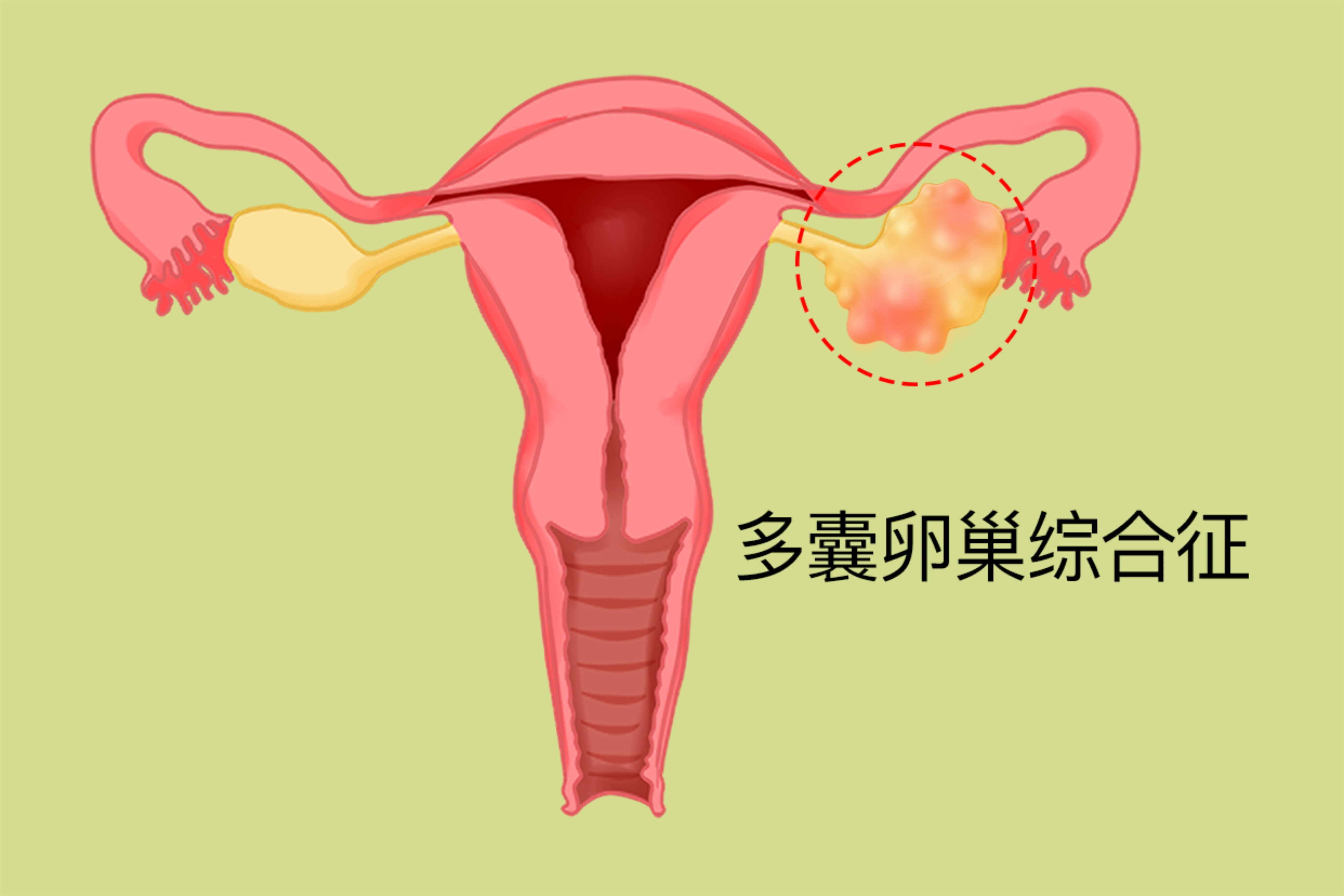 多囊性卵巢的症状_多囊性卵巢的症状有哪些