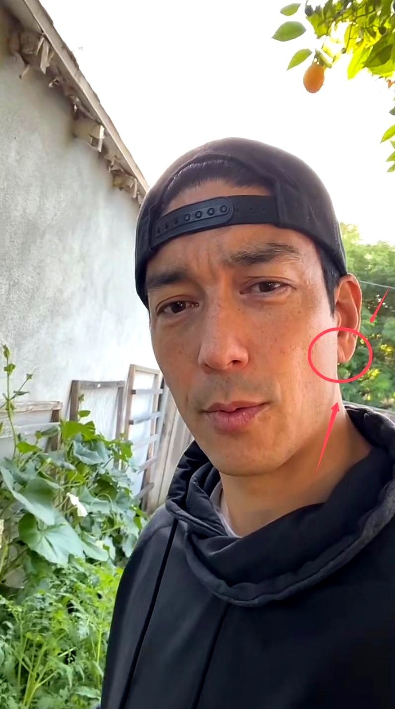 发现,他的耳垂上似乎出现了"耳褶心征",这可不是小事,不少人纷纷喊话