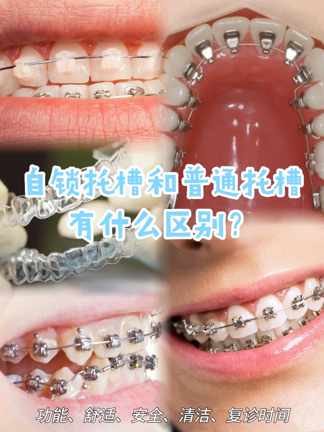 陶瓷自锁托槽与普通托槽的区别 想要矫正牙齿却纠结托槽怎么选?