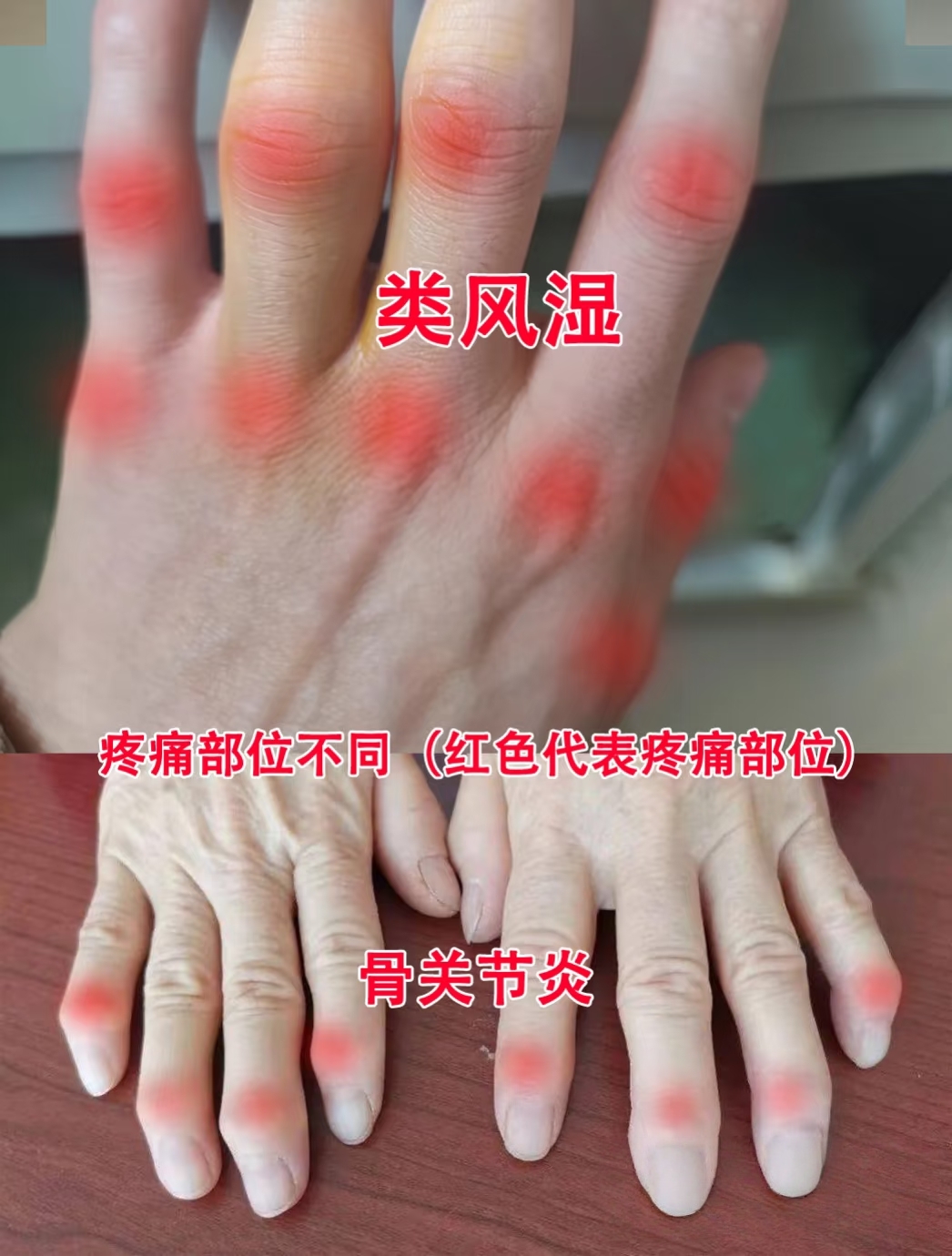 常见症状:关节痛,或伴有关节肿,关节僵硬感