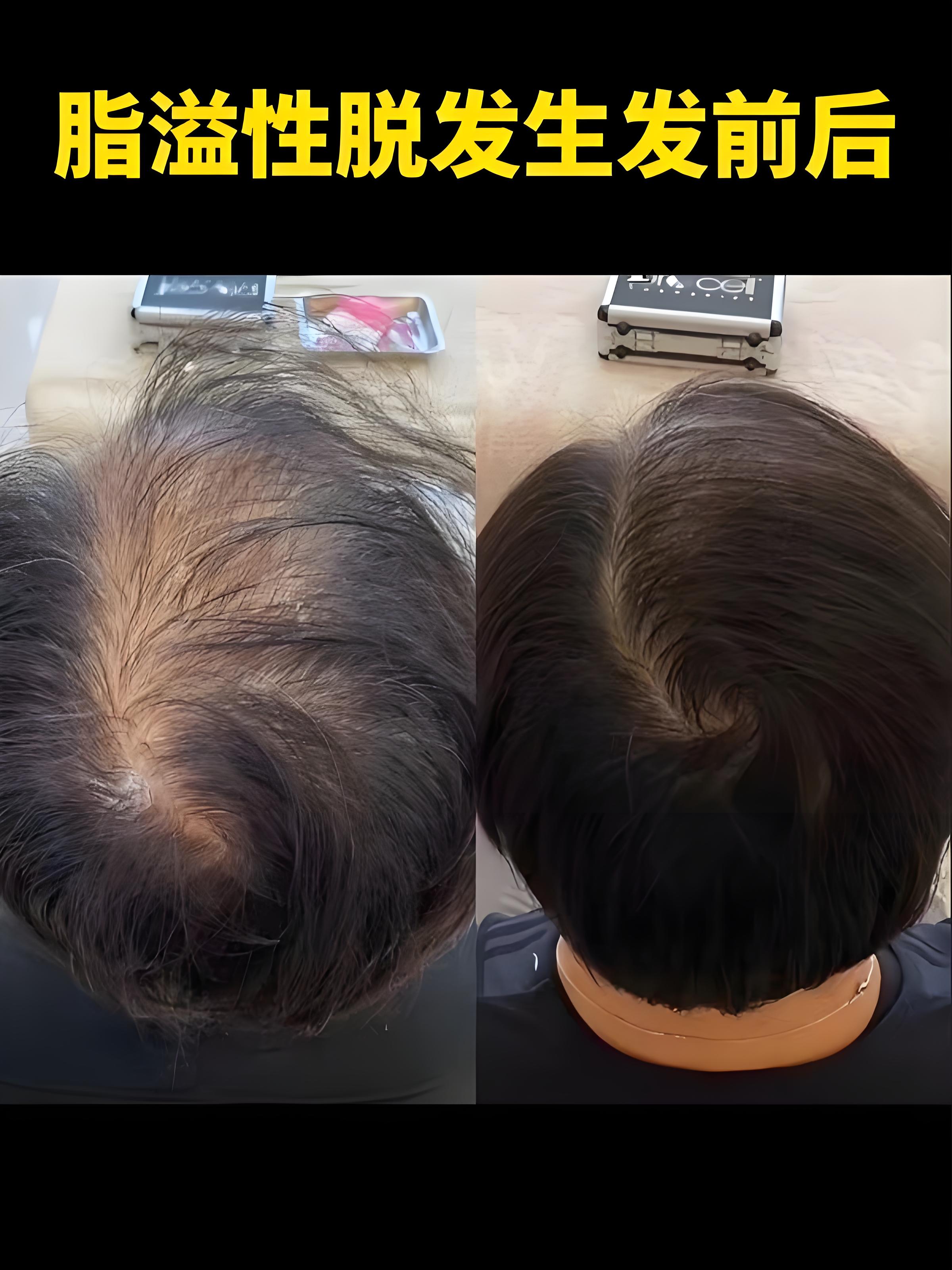 怎么生发最有效方法