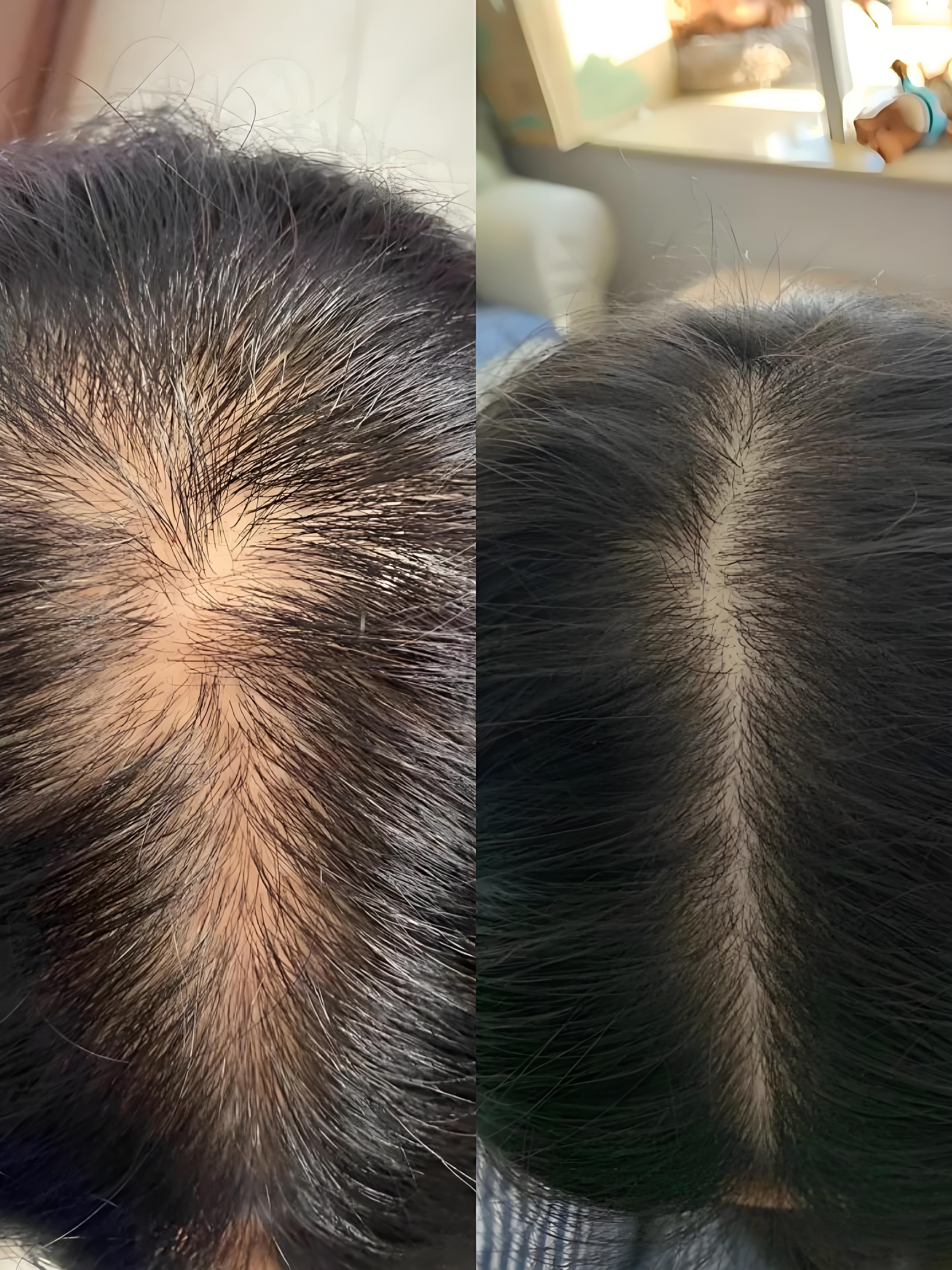 那种对形象的焦虑,对自信的打击,只有经脱发正常头顶头顶头发全头脱发